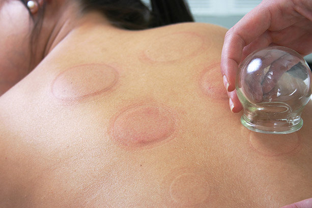 Cupping Therapy