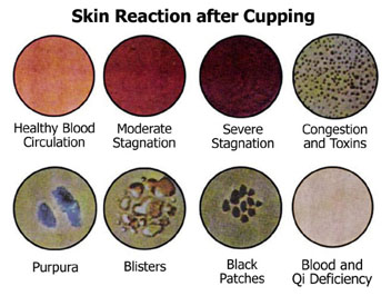 cupping reactions